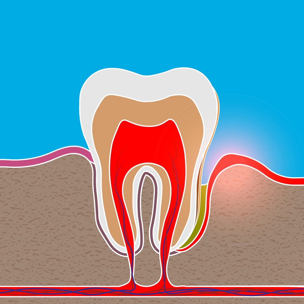 Tooth Pes What Does A Tooth Pocket Look Like at Nancy Sheridan blog