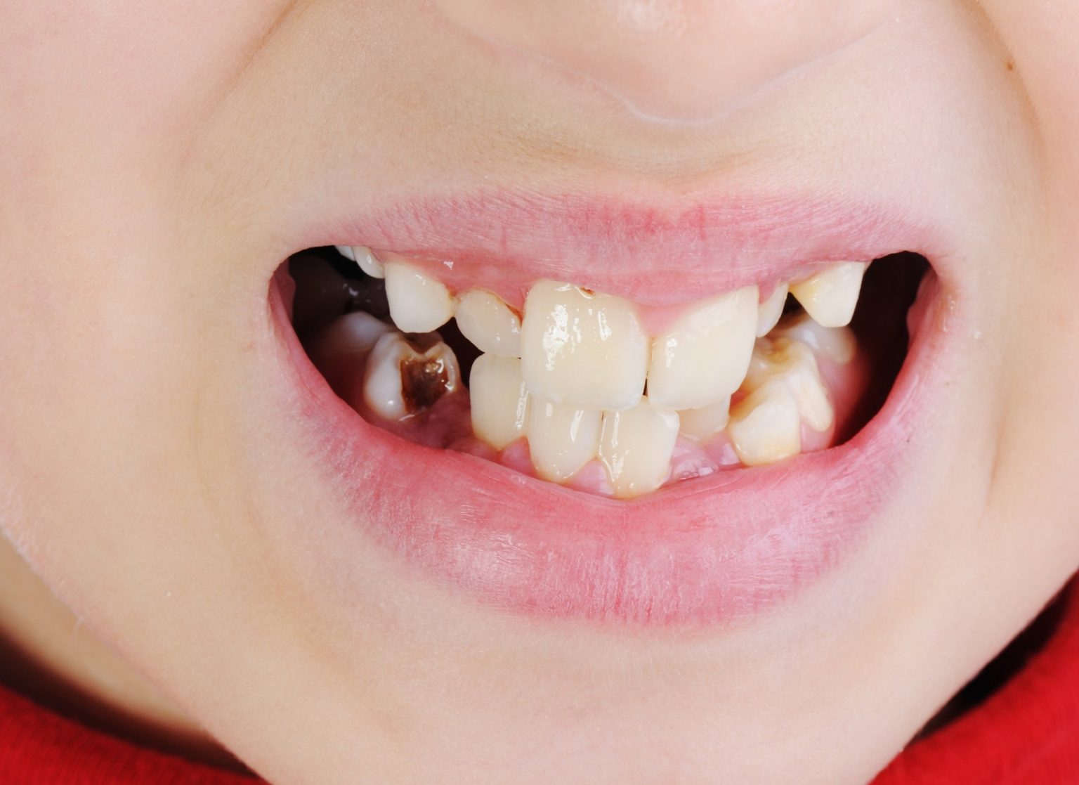 When Should My Child First Have Dental XRays?