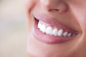 can you whiten dental crowns